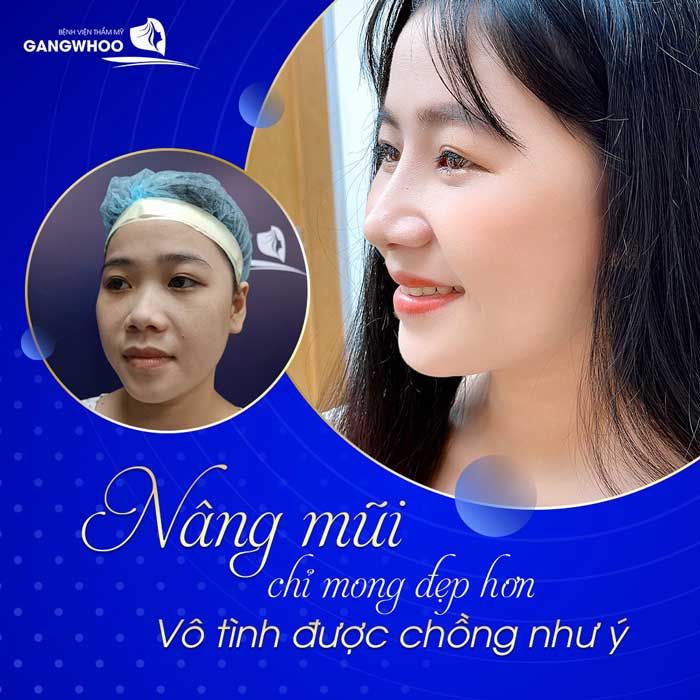 Lấy chồng như ý sau khi phẫu thuật nâng mũi tại Bệnh viện nâng mũi Gangwhoo