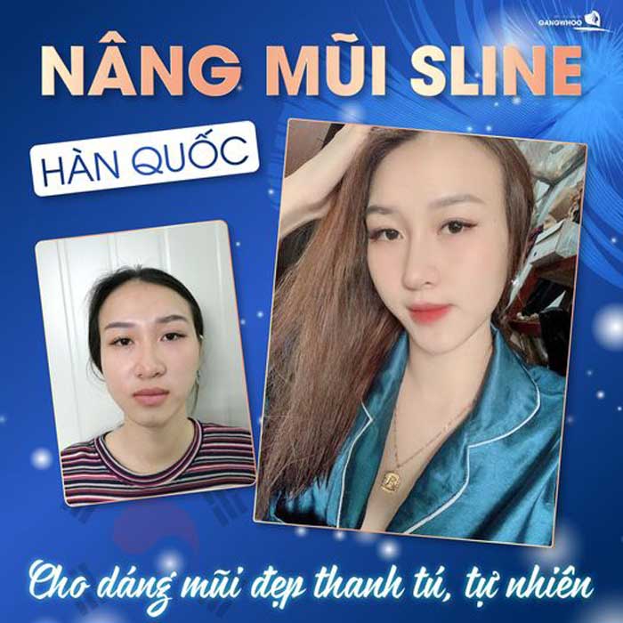 Nâng mũi Hàn Quốc dáng S Line