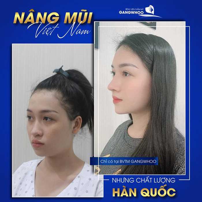 Nâng mũi Hàn Quốc thăng hạn nhan sắc tức thì tại Bệnh viện sửa mũi thẩm mỹ Gangwhoo