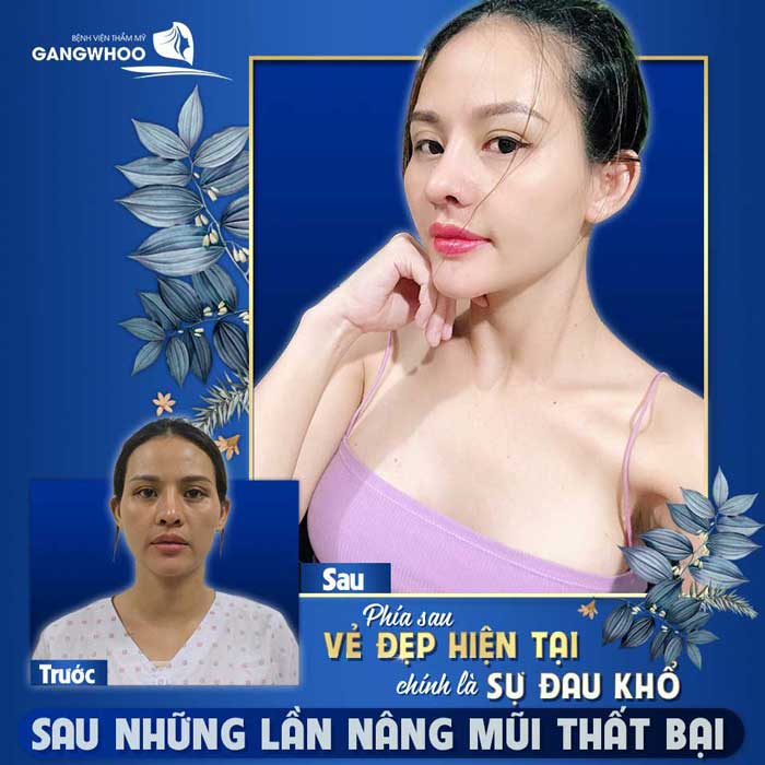 Nâng Mũi Bọc Sụn Gangwhoo Dáng Mũi Đẹp Tự Nhiên