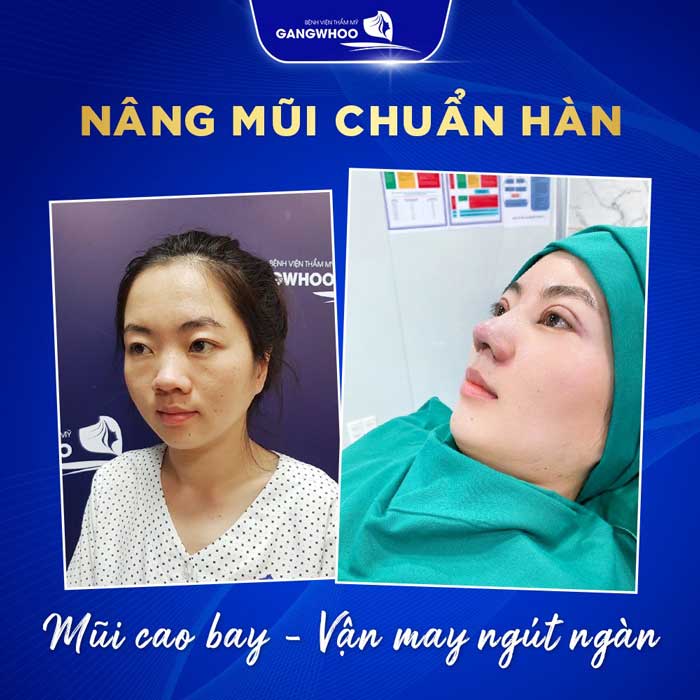 Nâng Mũi Ở Đâu Đẹp Tại Đắk Nông