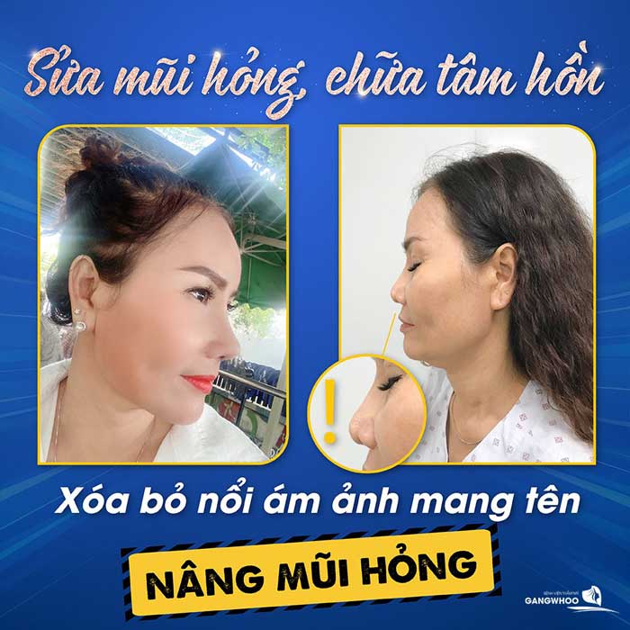 Nâng Mũi Ở Đâu Đẹp Tại Đồng Nai