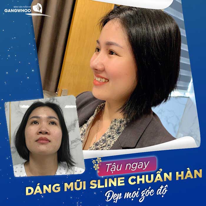 Dáng mũi S Line nét đẹp chuẩn Á Đông 