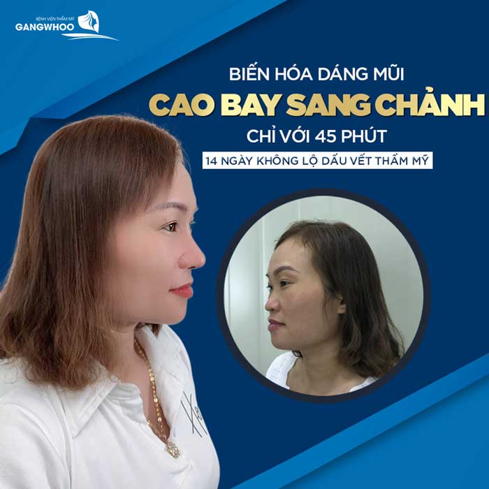 Mũi Cao Thẳng Tắp Khi Mài Gồ Xương Mũi BVTM Gangwhoo