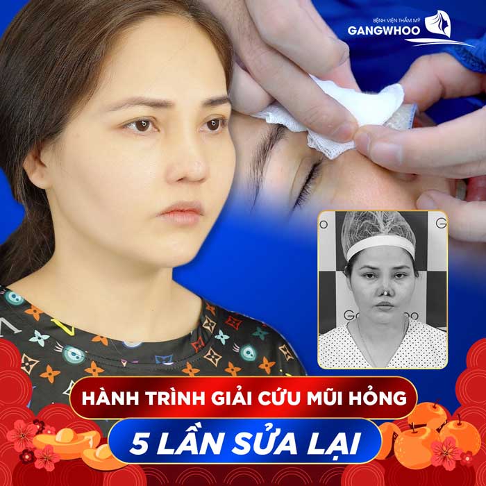 Nâng Mũi Ở Đâu Đẹp Tại Tây Ninh?