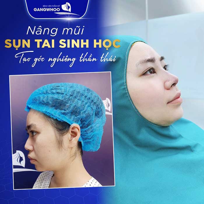 Nâng Mũi Ở Đâu Đẹp Tại Thành Phố Hồ Chí Minh