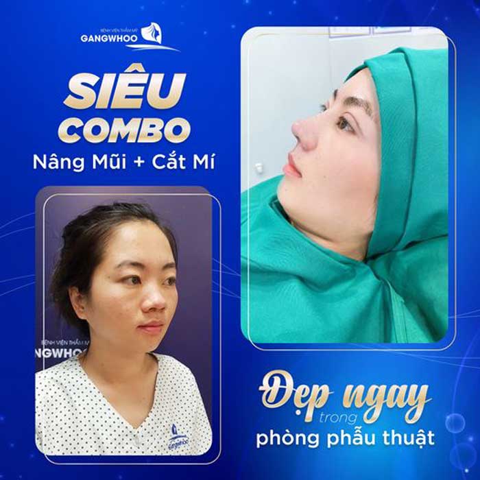 Địa Chỉ Nâng Mũi Ở Đâu Đẹp Tại Trà Vinh