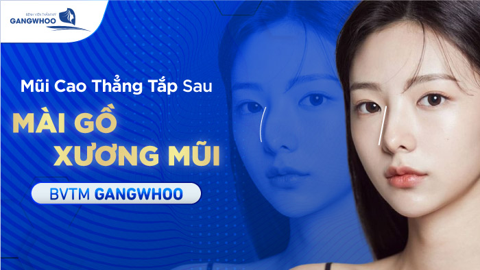 Mũi Cao Thẳng Tắp Khi Mài Gồ Xương Mũi BVTM Gangwhoo