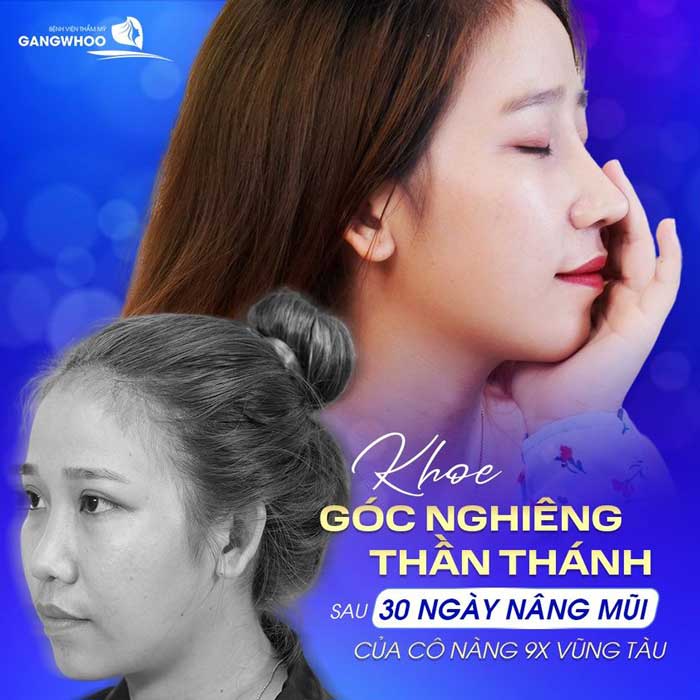 hách Hàng Nâng Mũi Sụn Sườn Dáng Mũi Cao Tự Nhiên - Đẹp Bền Bỉ 2022