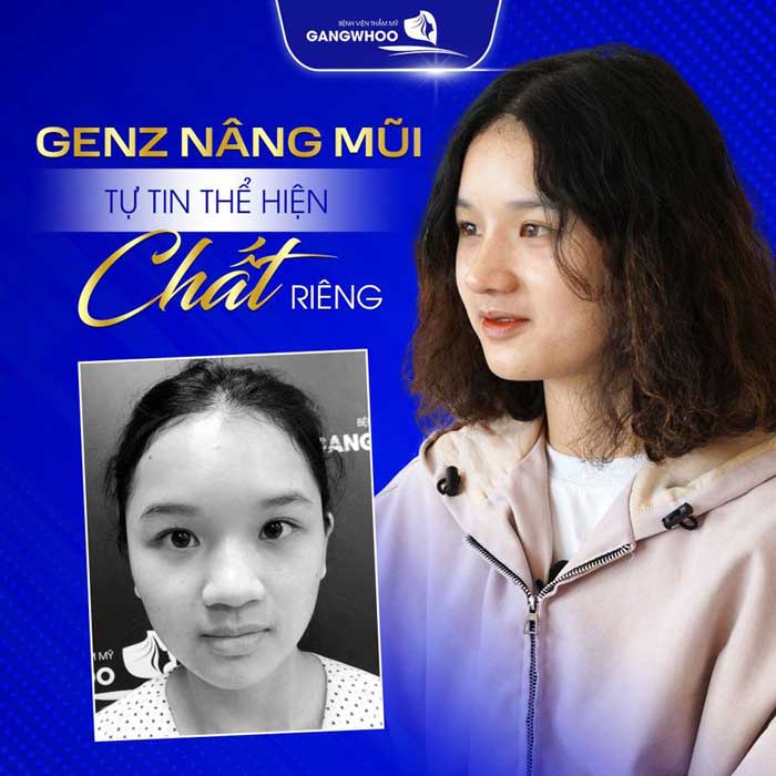 Nâng Mũi Bằng Chỉ Là Gì? Có Nên Nâng Mũi Bằng Chỉ Không?