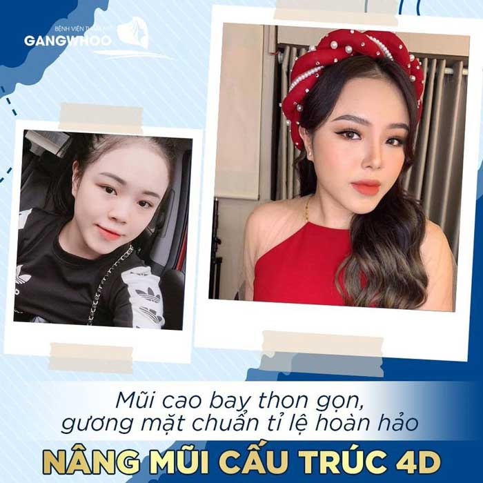 Hot Trend Nâng Mũi Siêu Cao "Đẹp Chuẩn Gái Tây"