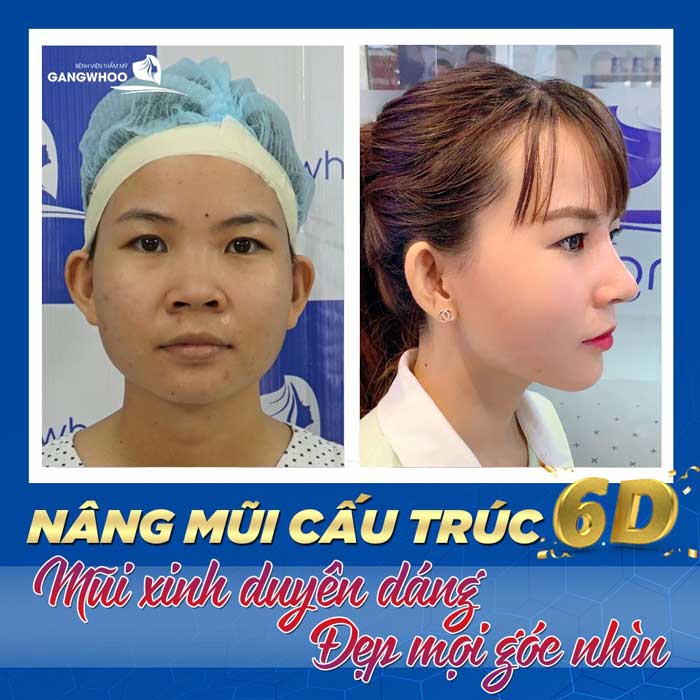 Bật mí nâng mũi ở đâu đẹp tại Phú Yên uy tín