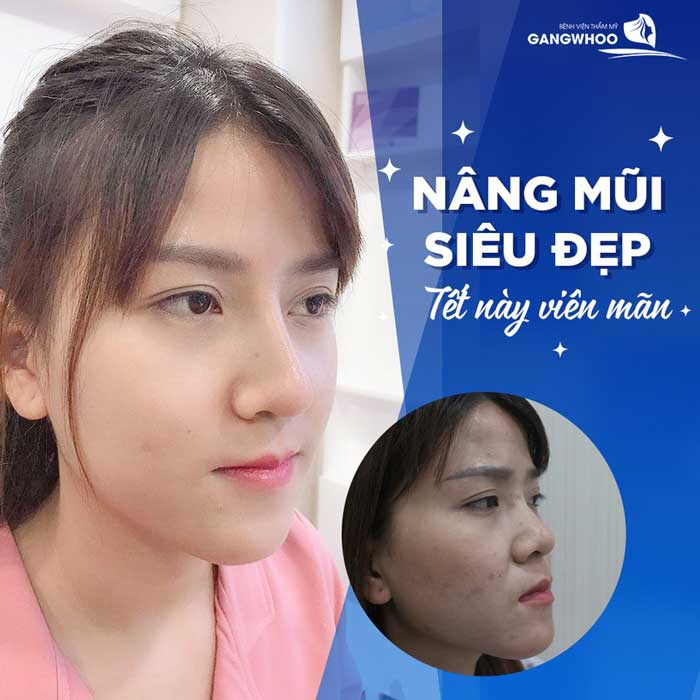 Hot Trend Nâng Mũi Siêu Cao "Đẹp Chuẩn Gái Tây"