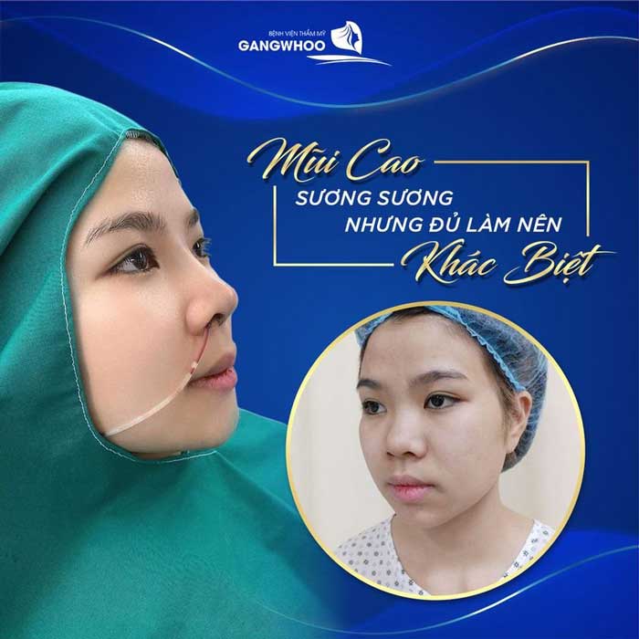 Hot Trend Nâng Mũi Siêu Cao "Đẹp Chuẩn Gái Tây"