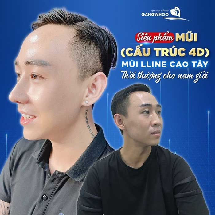 Hot Trend Nâng Mũi Siêu Cao "Đẹp Chuẩn Gái Tây"