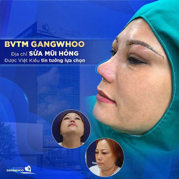 Khách hàng sửa mũi hỏng tại BVTM Gangwhoo