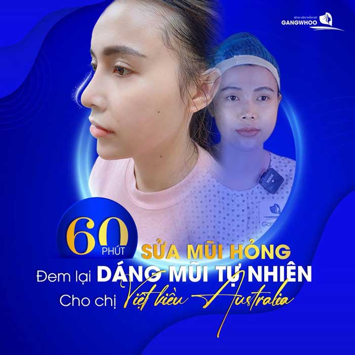 Khách hàng sửa mũi hỏng tại BVTM Gangwhoo