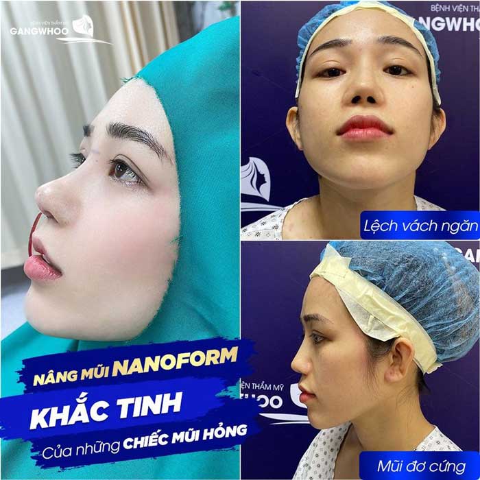 Khách hàng sửa mũi hỏng tại BVTM Gangwhoo