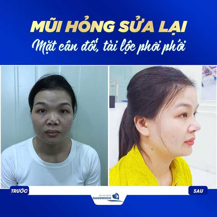 Khách hàng sửa mũi hỏng tại BVTM Gangwhoo