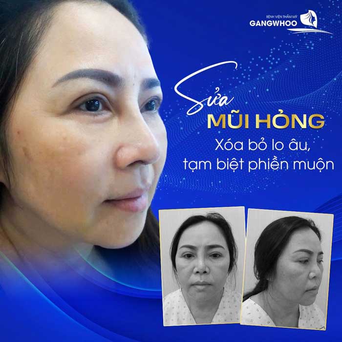 Khách hàng sửa mũi hỏng tại BVTM Gangwhoo