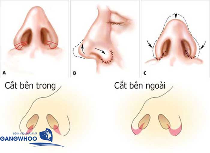 Khuôn Mặt Đẹp Sau Thu Gọn Cánh Mũi Tại BVTM Gangwhoo