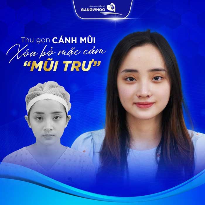 Khuôn Mặt Đẹp Sau Thu Gọn Cánh Mũi Tại BVTM Gangwhoo