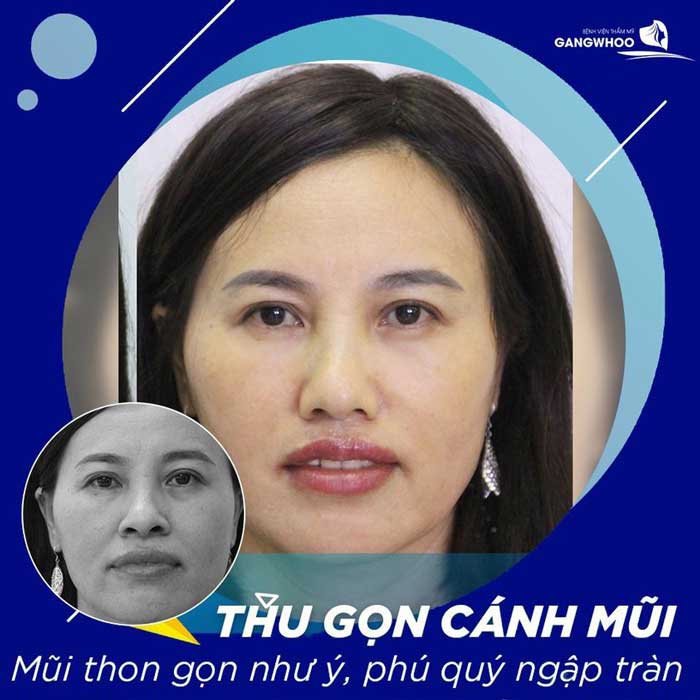 Khách hàng thẩm mỹ mũi đẹp tại BVTM Gangwhoo