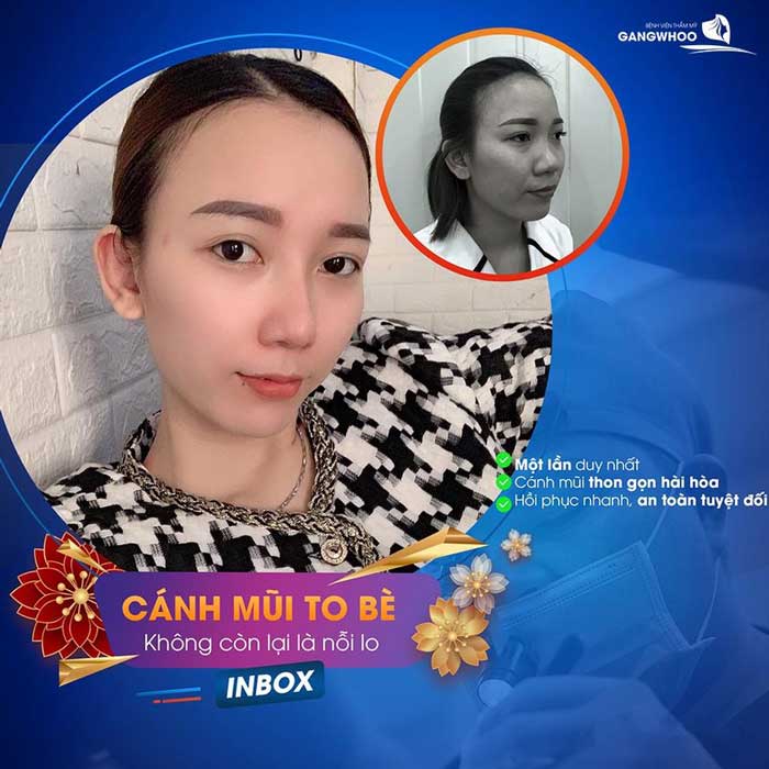 Khách hàng thẩm mỹ mũi đẹp tại BVTM Gangwhoo