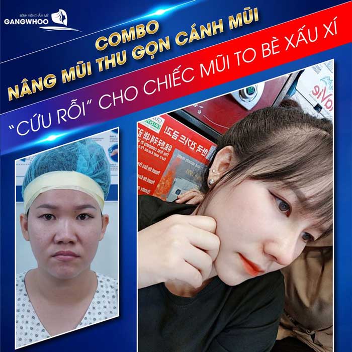 Khách hàng thẩm mỹ mũi đẹp tại BVTM Gangwhoo