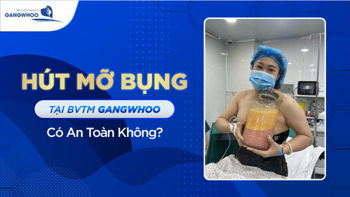 Hút Mỡ Bụng Tại BVTM Gangwhoo Có An Toàn Không