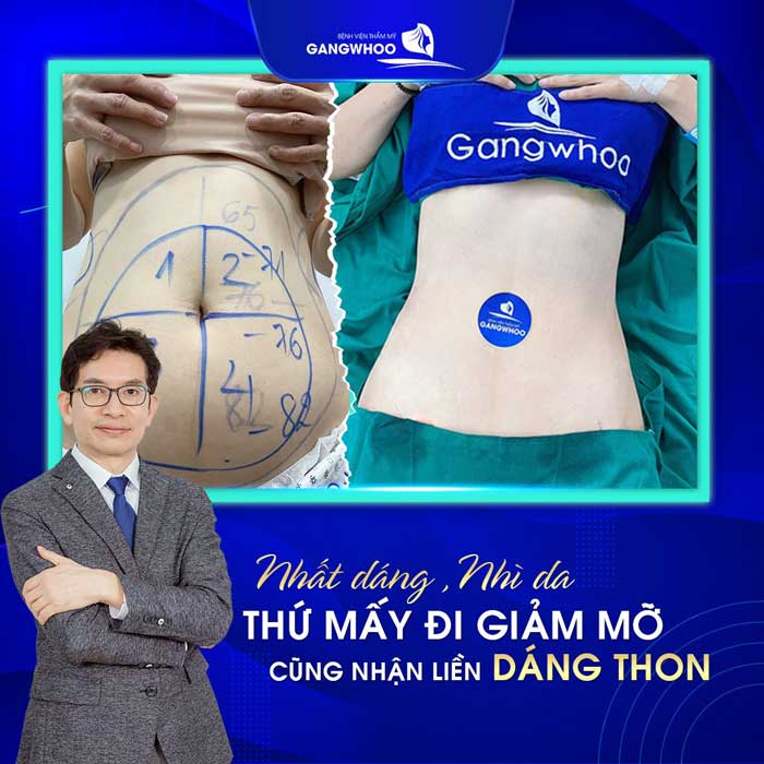 Hút Mỡ Bụng Tại BVTM Gangwhoo Có Tốt Không?