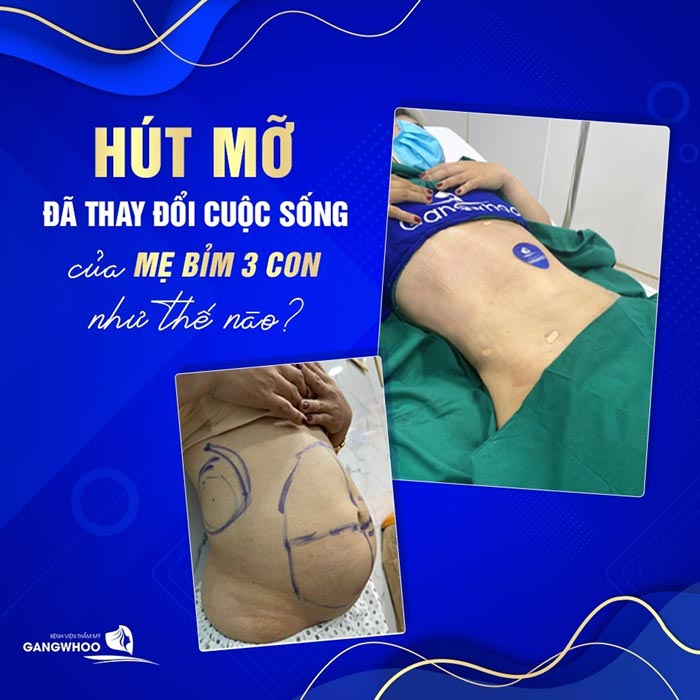 Bệnh viện thẩm mỹ Gangwhoo - địa chỉ hút mỡ bụng uy tín