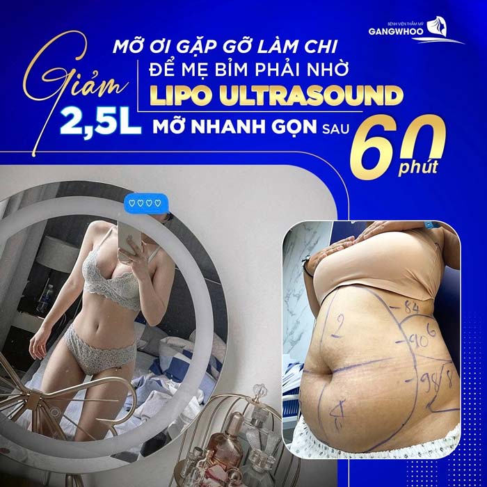 Bệnh viện thẩm mỹ Gangwhoo - chỉ với 60p nhanh chóng đánh bay mỡ thừa lấy lại vóc dáng hằng mơ ước