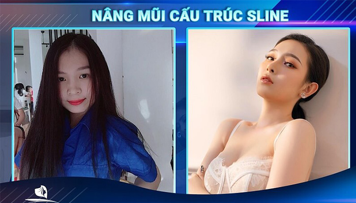 Bạn đã “lột xác” ngoạn mục khi nâng mũi Sline