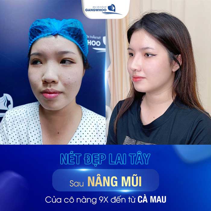 Vậy khi Bị viêm mũi dị ứng có nâng mũi được không