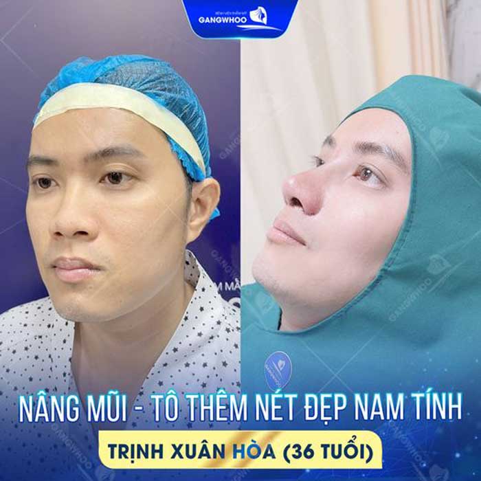 Các Câu Hỏi Thường Gặp Khi Nâng Mũi Cấu Trúc