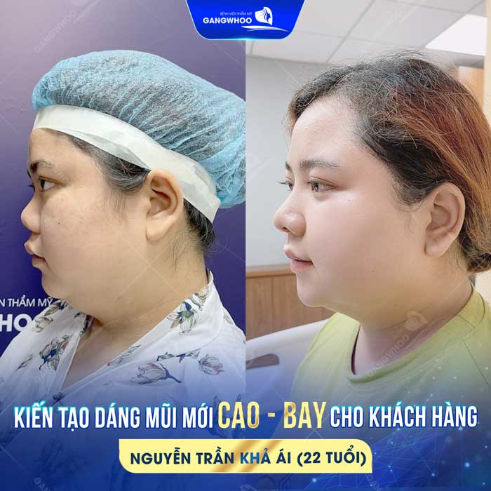 Muốn Nâng Mũi Ở Thái Bình? Đây Là 5 Địa Chỉ Bạn Phải Biết