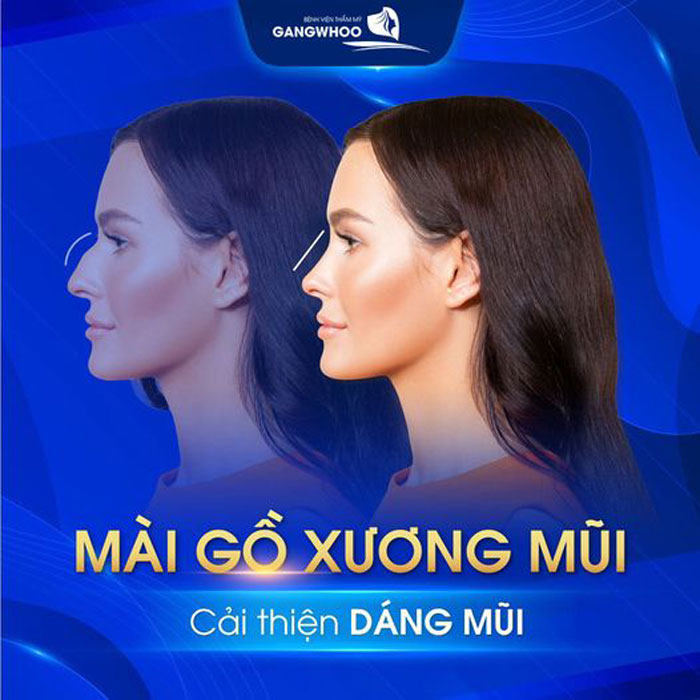 Mài gồ xương mũi