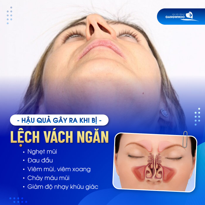 Chỉnh hình vách ngăn