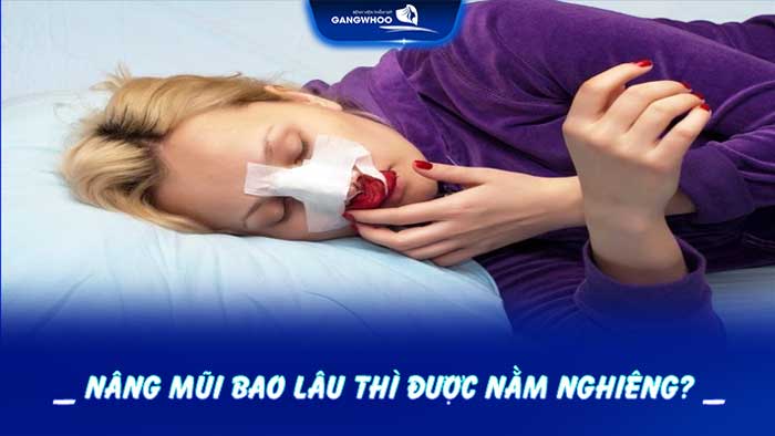 Nâng mũi bao lâu thì được nằm nghiêng