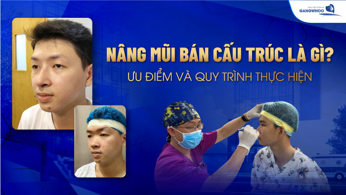 Nâng mũi bán cấu trúc