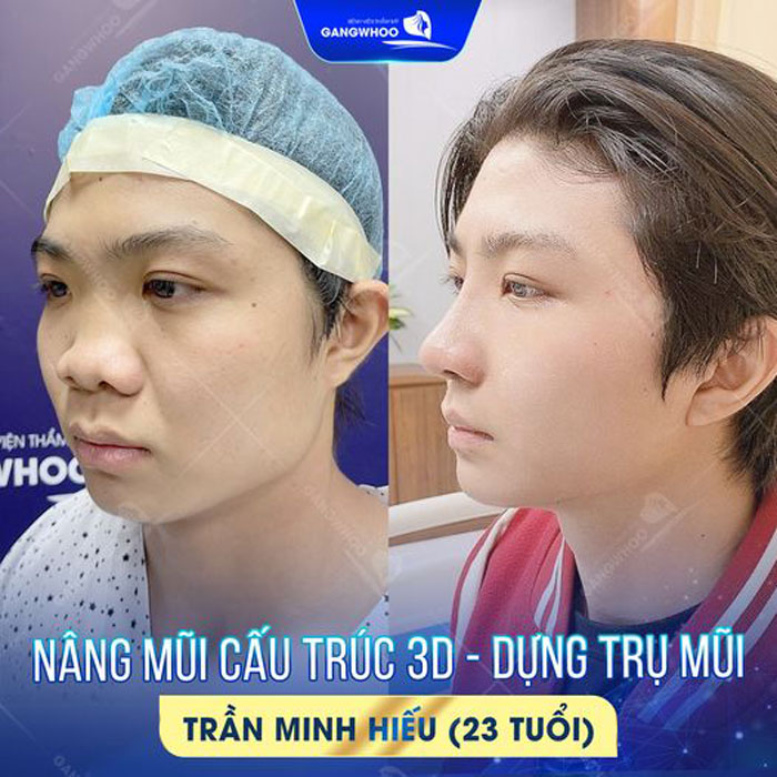 Những trường hợp không được nâng mũi