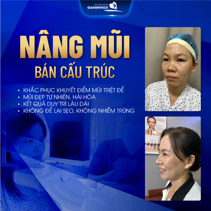 Nâng mũi bán cấu trúc