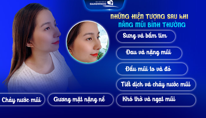  Những Hiện Tượng Sau Khi Nâng Mũi