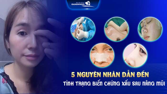  Những Hiện Tượng Sau Khi Nâng Mũi