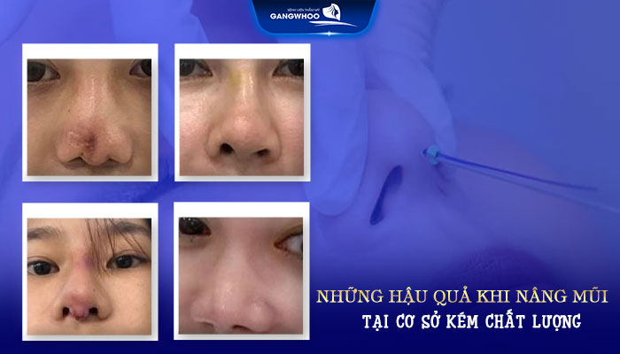 Nâng Mũi Có Hại Về Sau Không