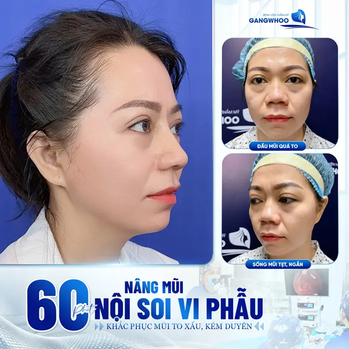 Lưu Ngay Top 5 Địa Chỉ Nâng Mũi Ở Quảng Ngãi Tốt Nhất Hiện Nay