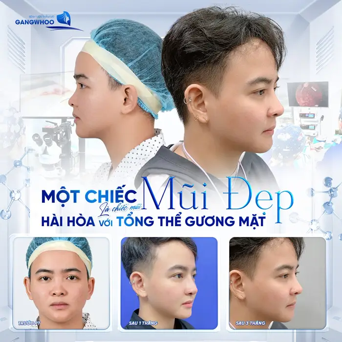  5 Địa Chỉ Nâng Mũi Ở Đắk Lắk – Top Cơ Sở Uy Tín, An Toàn 