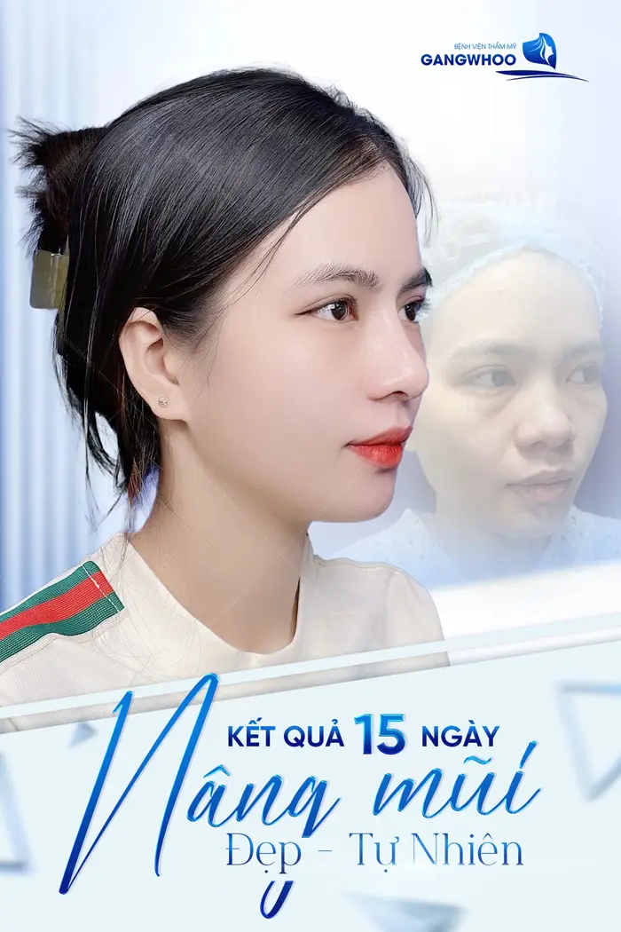 Cập Nhật 5 Địa Chỉ Nâng Mũi Ở Nghệ An Uy Tín Không Nên Bỏ Lỡ