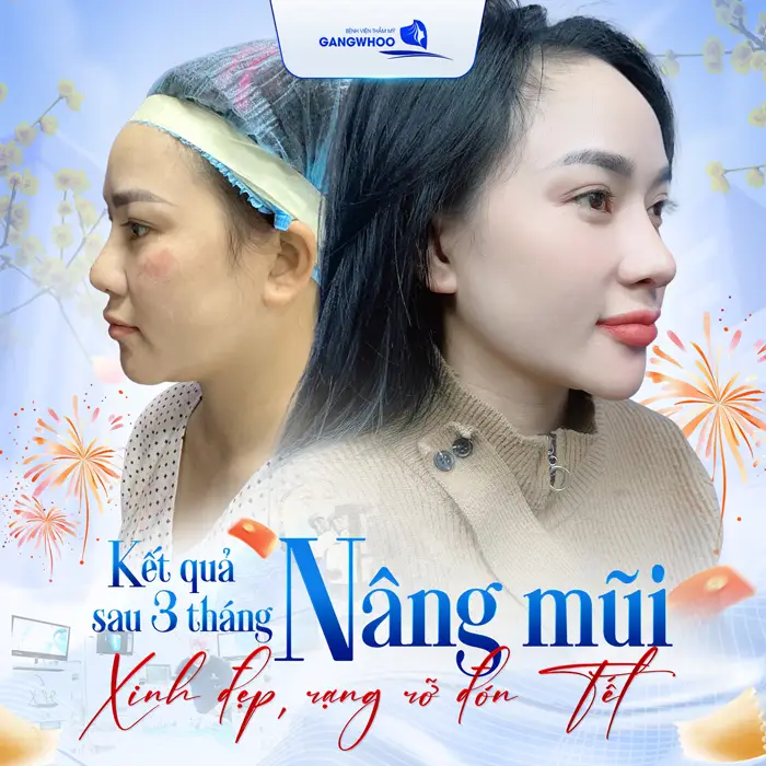 Review 5 Địa Chỉ Nâng Mũi Ở Bắc Ninh Top Đầu Về Chất Lượng